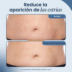 Crema Reafirmante Antiestrias para Abdomen