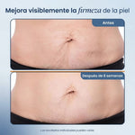 Crema Reafirmante Antiestrias para Abdomen